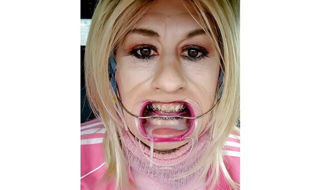 Headgear braces fetish featuring Alexandra Braces